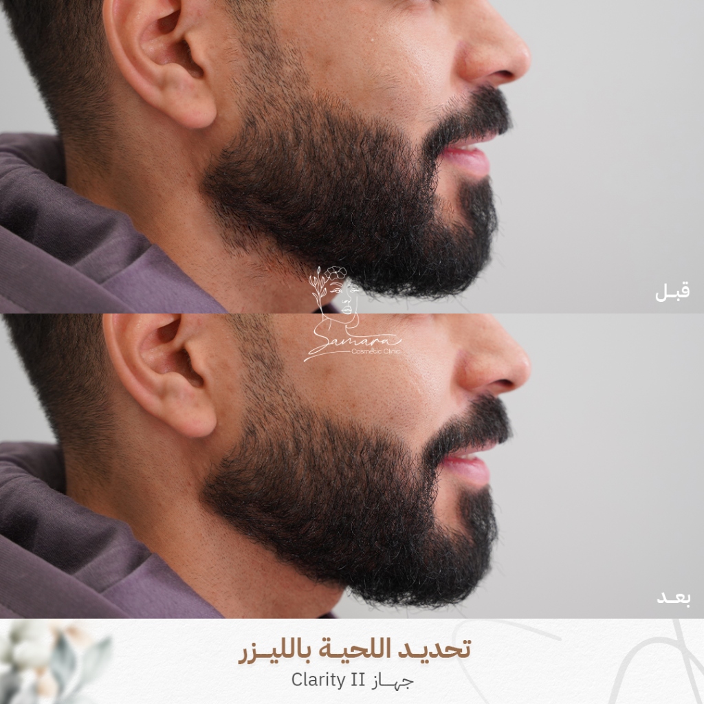 تحديد اللحية بالليزر