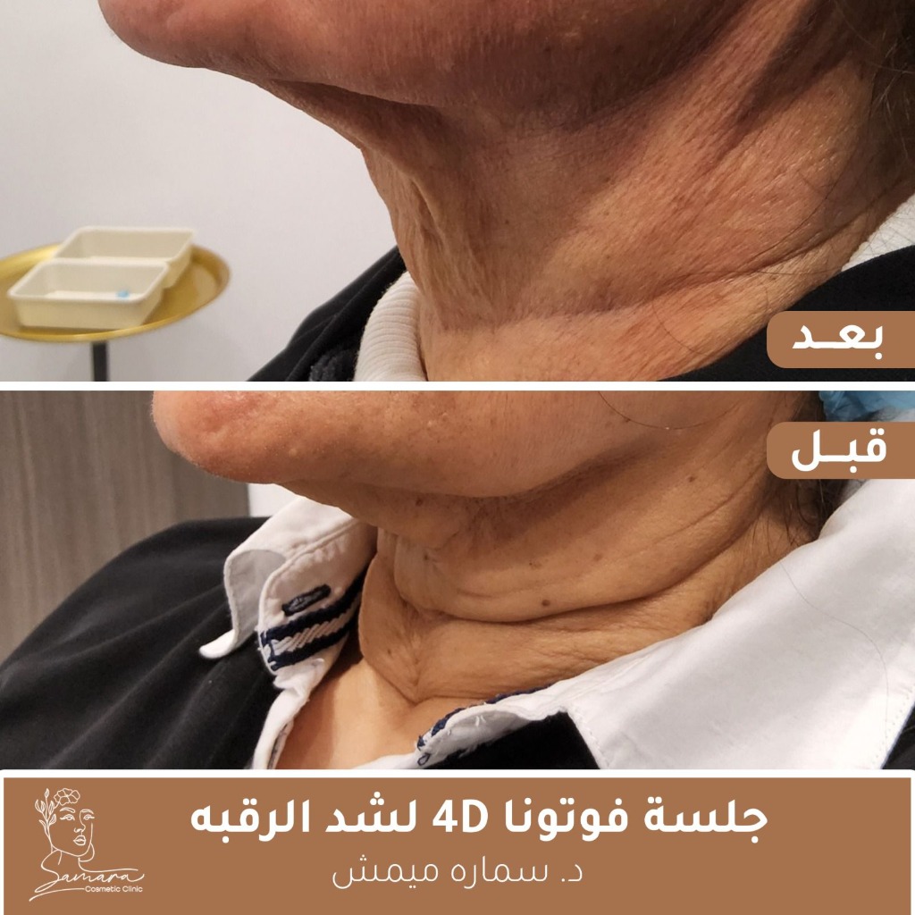 جلسة فوتونا 4D لشد الرقبة