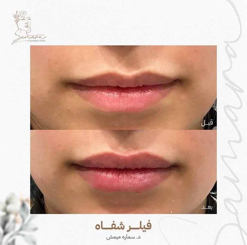 فيلر شفاه