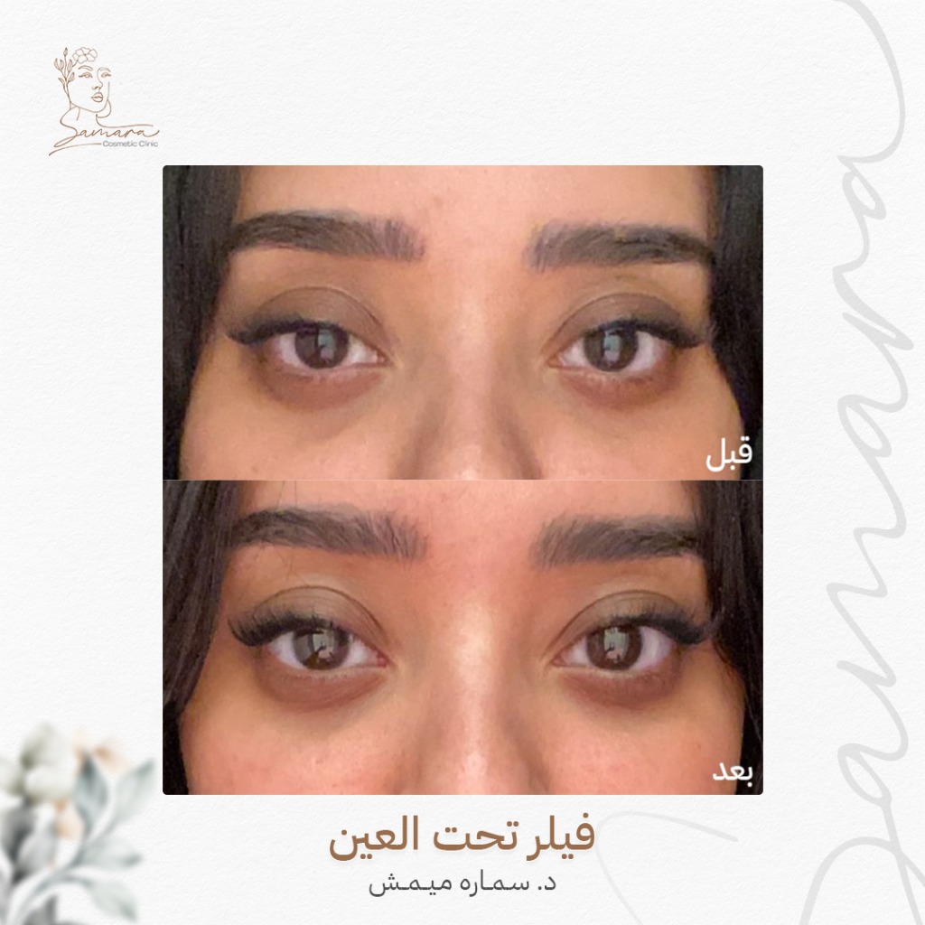 فيلر تحت العين
