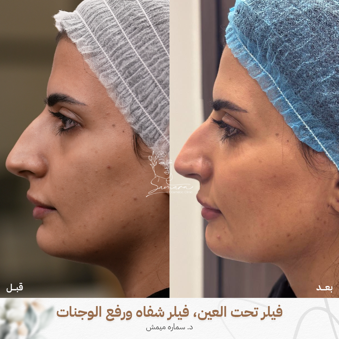 فيلر تحت العين والشفاه ورفع الوجنات