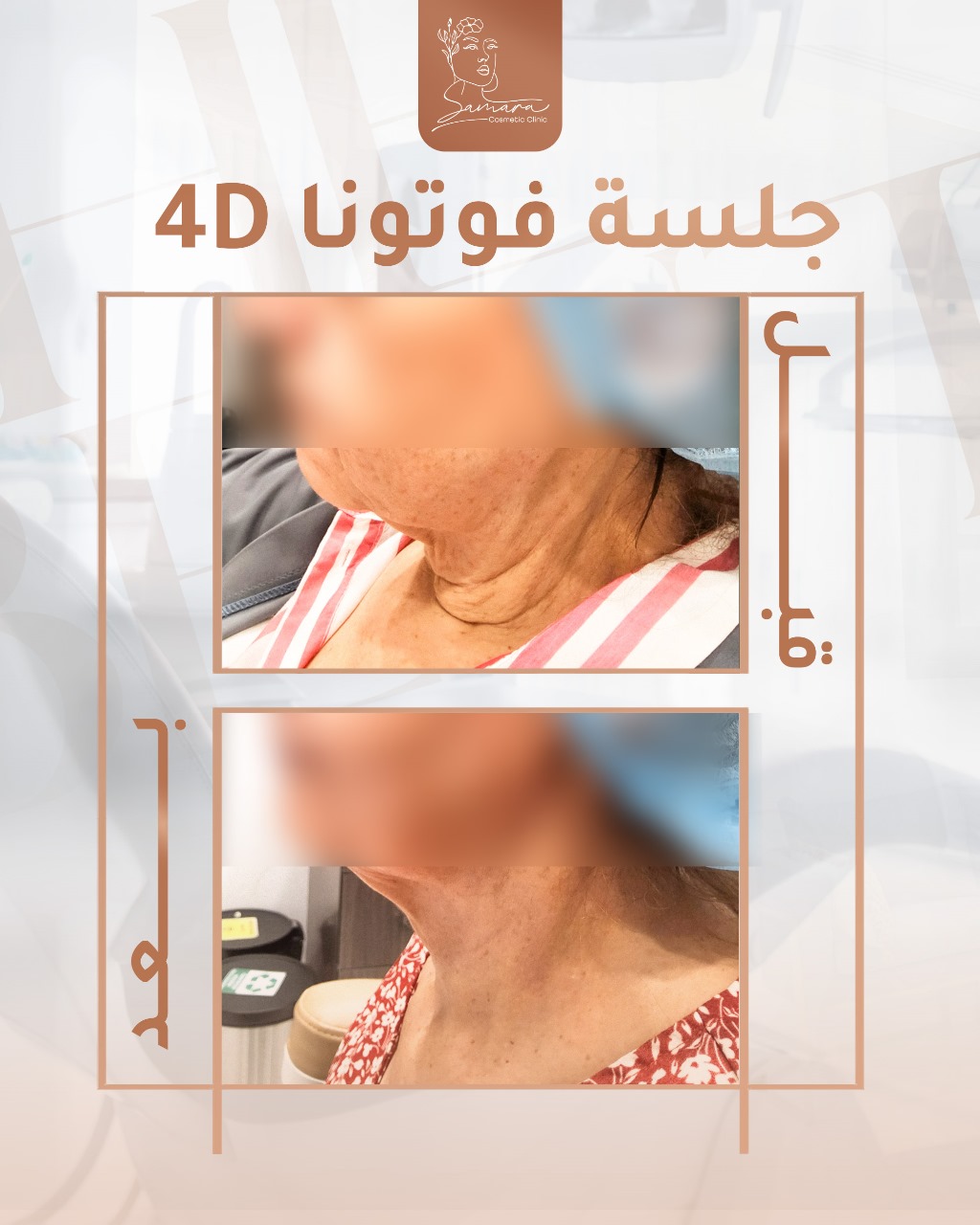 فوتونا4D للشد