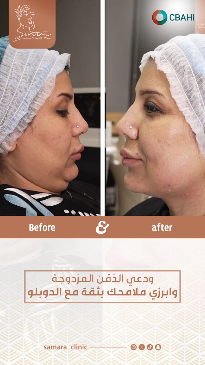 دوبلو لإذابة الذقن المزدوج وتحديد خط الفك