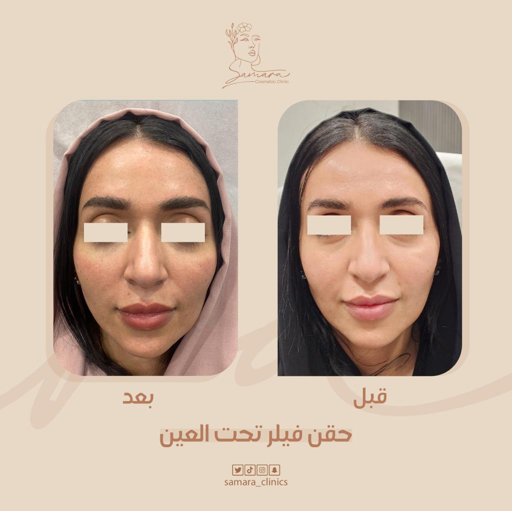 فيلر تحت العين