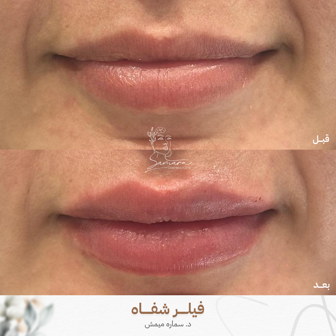 فيلر شفاه